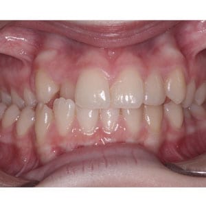 teeth with crossbite that will be corrected with invisalign at tri city dental care