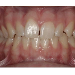 teeth with mild spacing that will be corrected with invisalign at tri city dental care