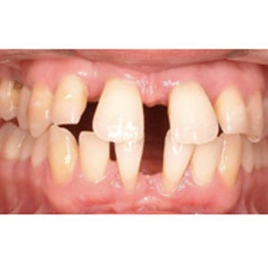 teeth with severe spacing that will be corrected with invisalign at tri city dental care