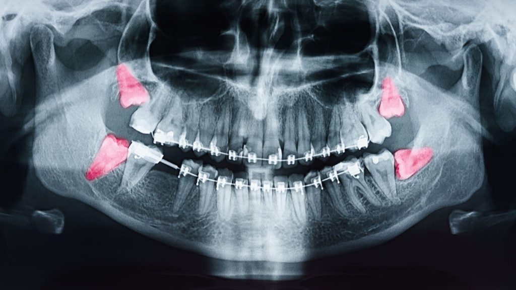 X-ray of a patient at Tri-City Dental Care showing impacted wisdom teeth