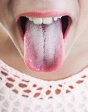 Image result for white coat on tongue