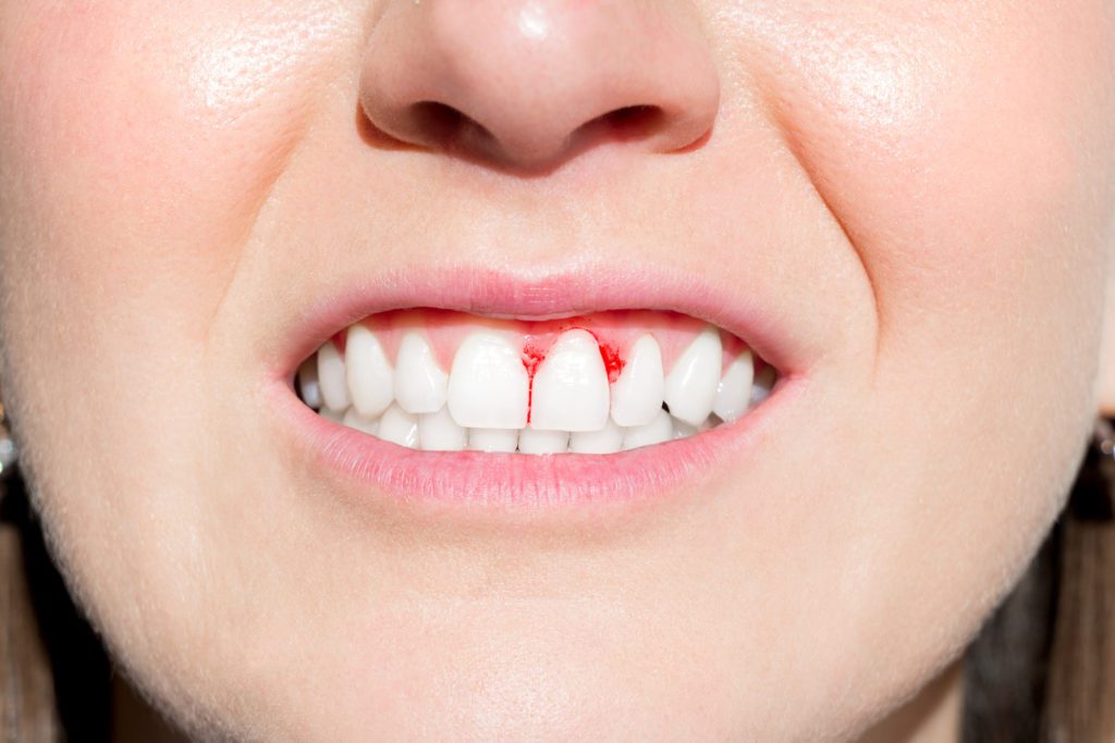 a woman with bleeding gums visits tri-city dental care to check on her gums