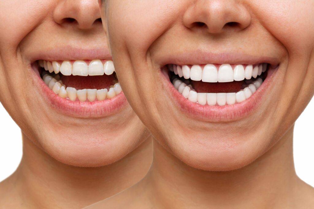 before and after image of a woman smiling after she gets porcelain veneers