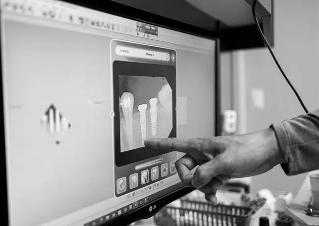 Dental Implants in Kennewick, WA - Tri City Dental Care